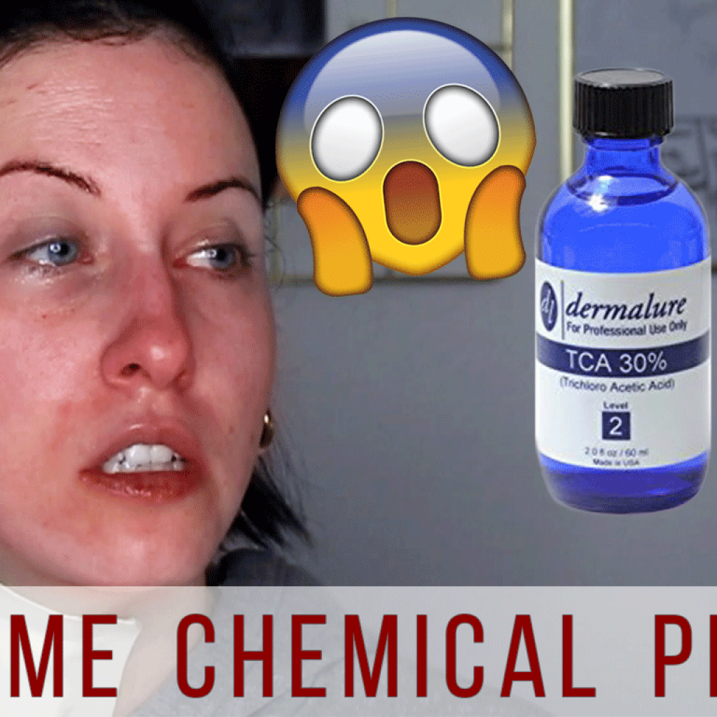 Chemical Peel Thumbnail